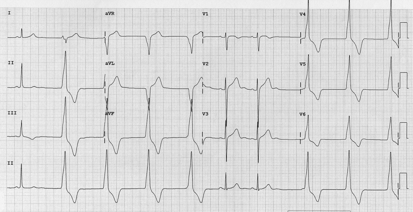 Accelerated Idioventricular Rhythm (AIVR)