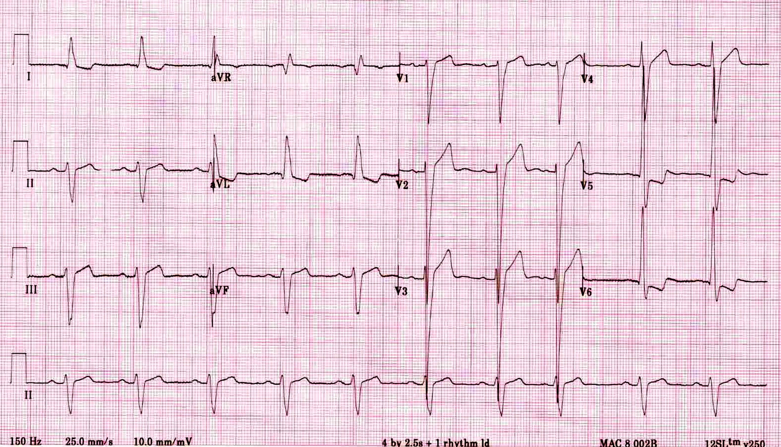 Left ventricular hyperthophy