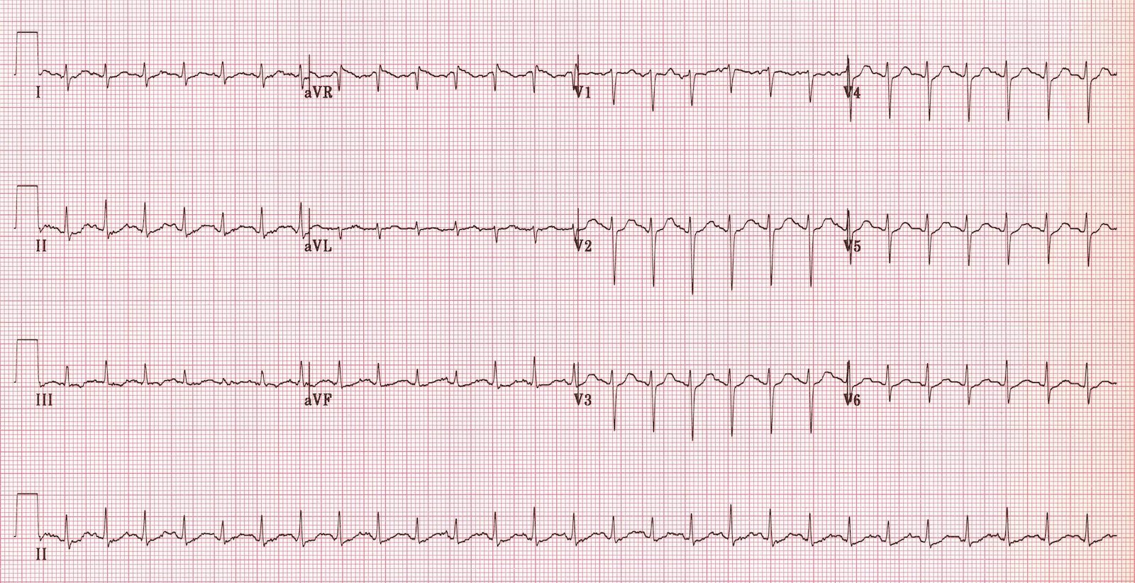 Sinus tachycardia