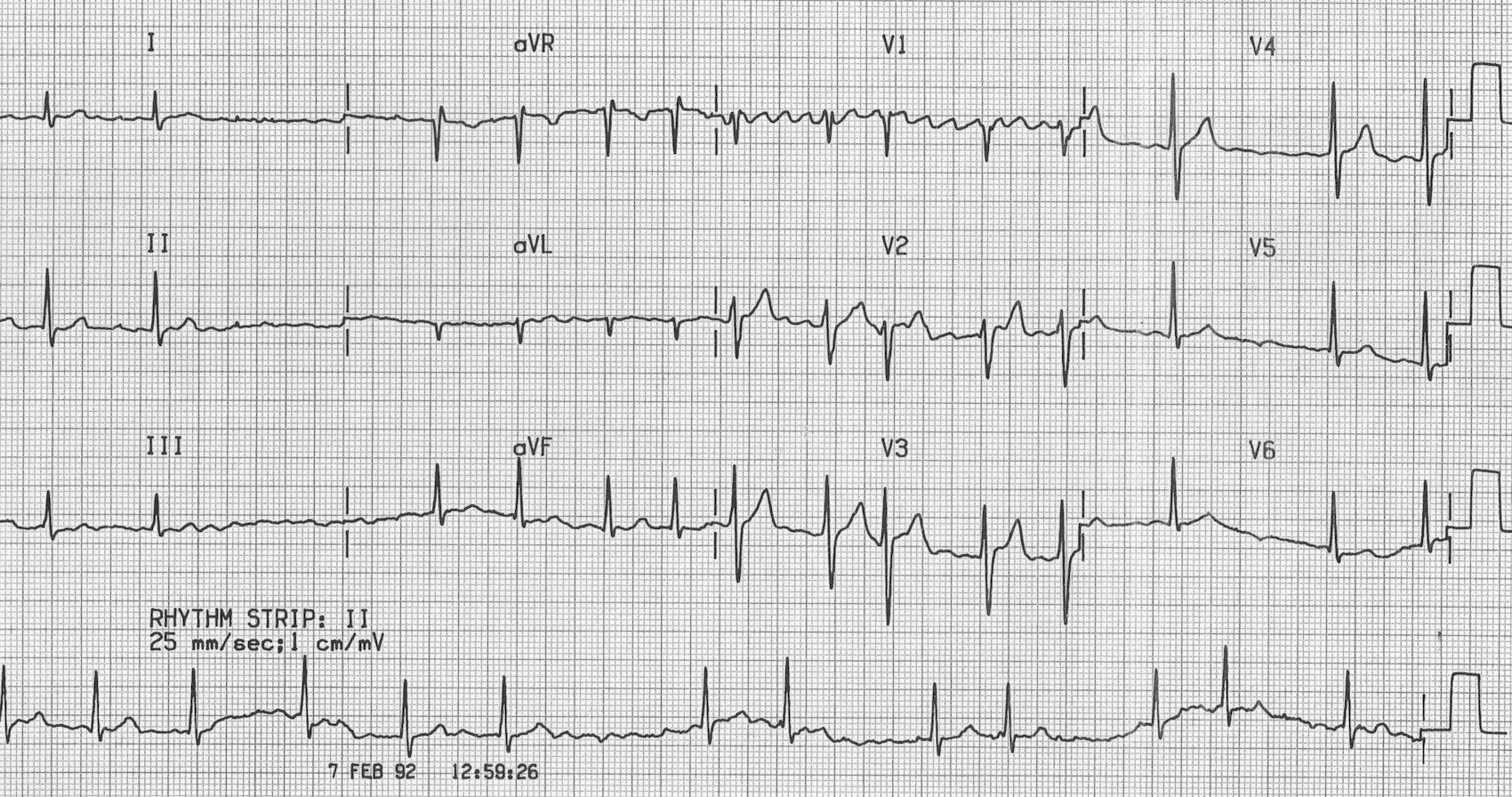 Atrial Fibrillation